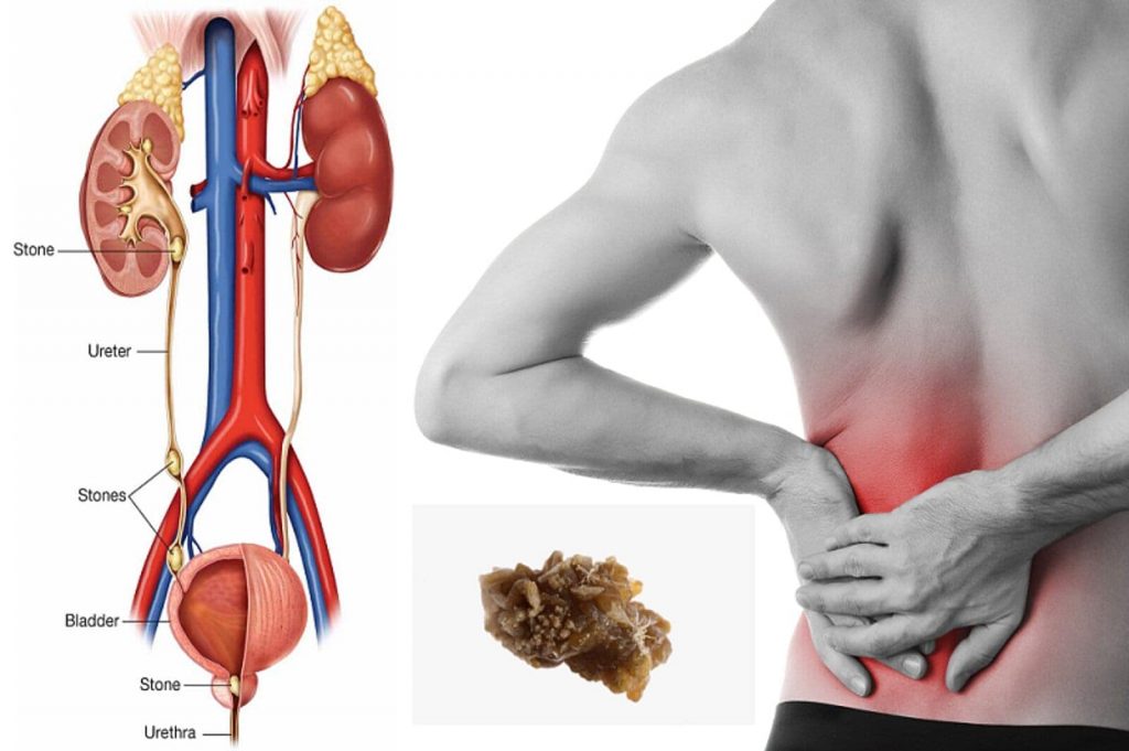 Citrate For Kidney Stones